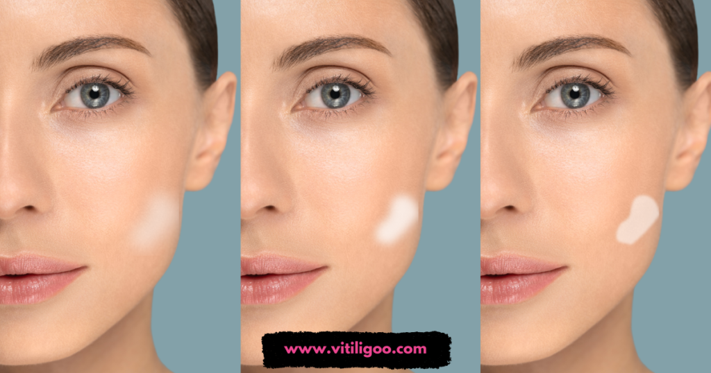 Early signs of vitiligo on the face showing small white patches near the Jawline and cheek.