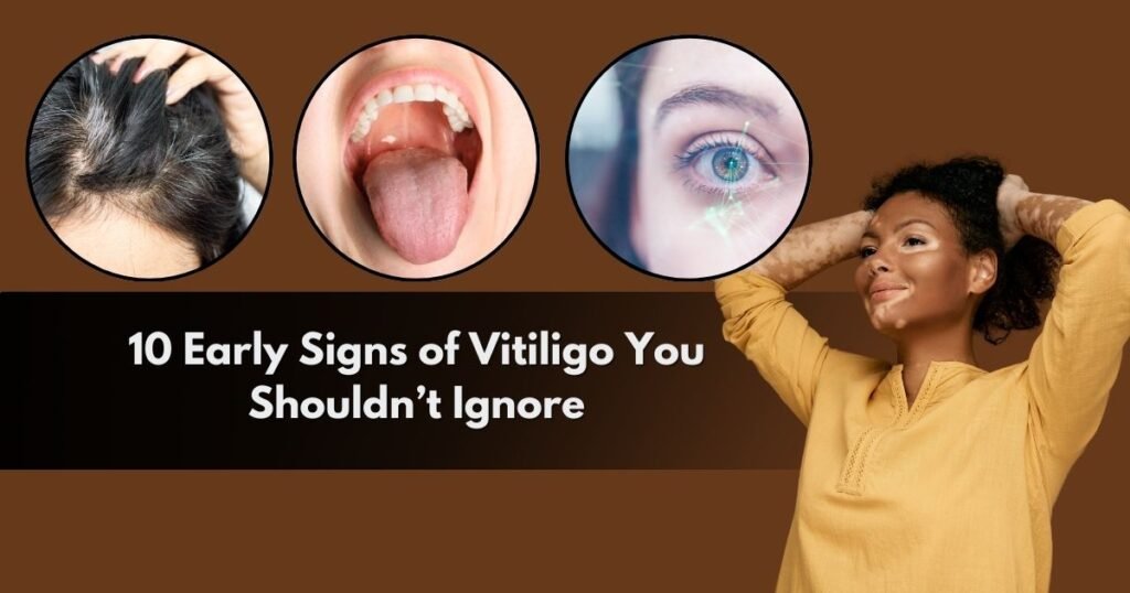 10 Early Signs of Vitiligo