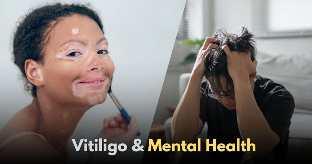 How Vitiligo Affects Mental Health Coping Tips and Resources