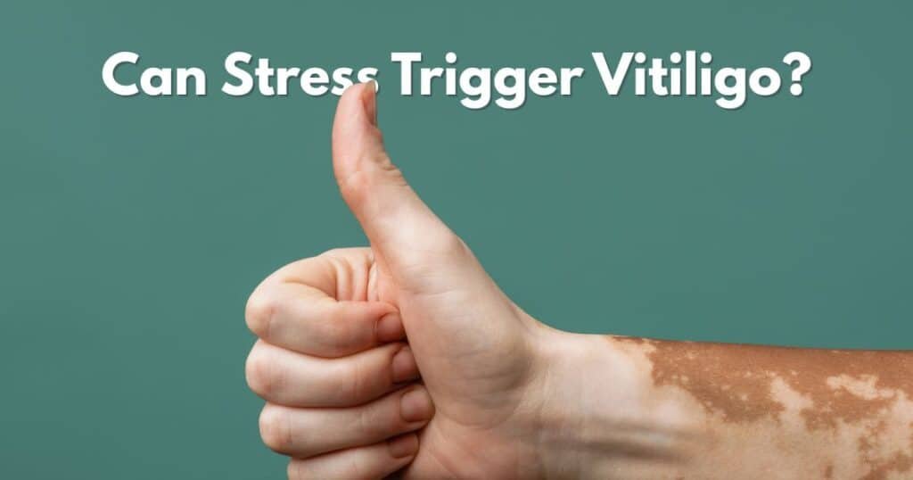 Can Stress Trigger Vitiligo? Here’s the Truth