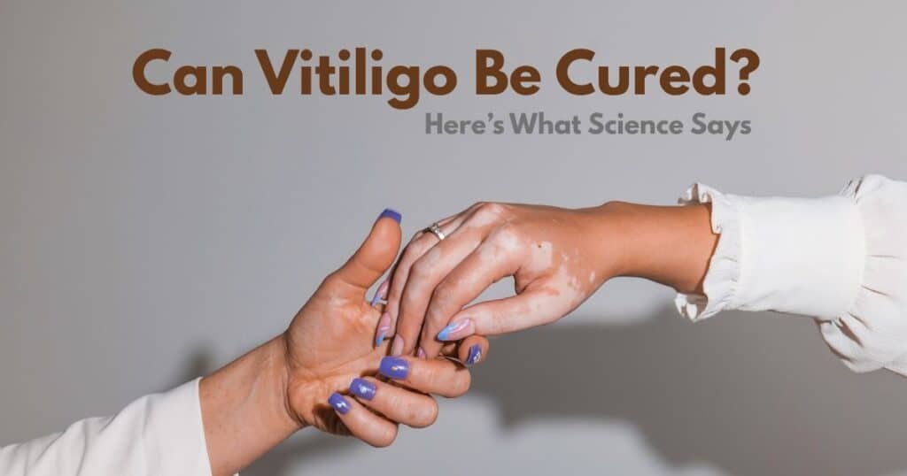 Can Vitiligo Be Cured? Here’s What Science Says