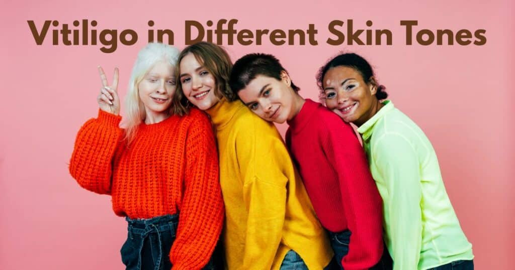 Vitiligo in Different Skin Tones