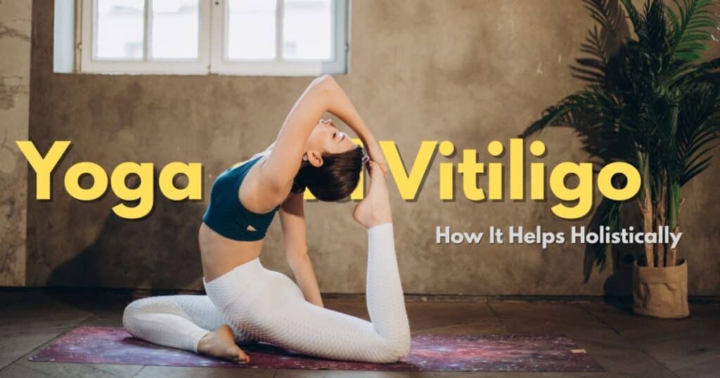 Yoga and Vitiligo How It Helps Holistically