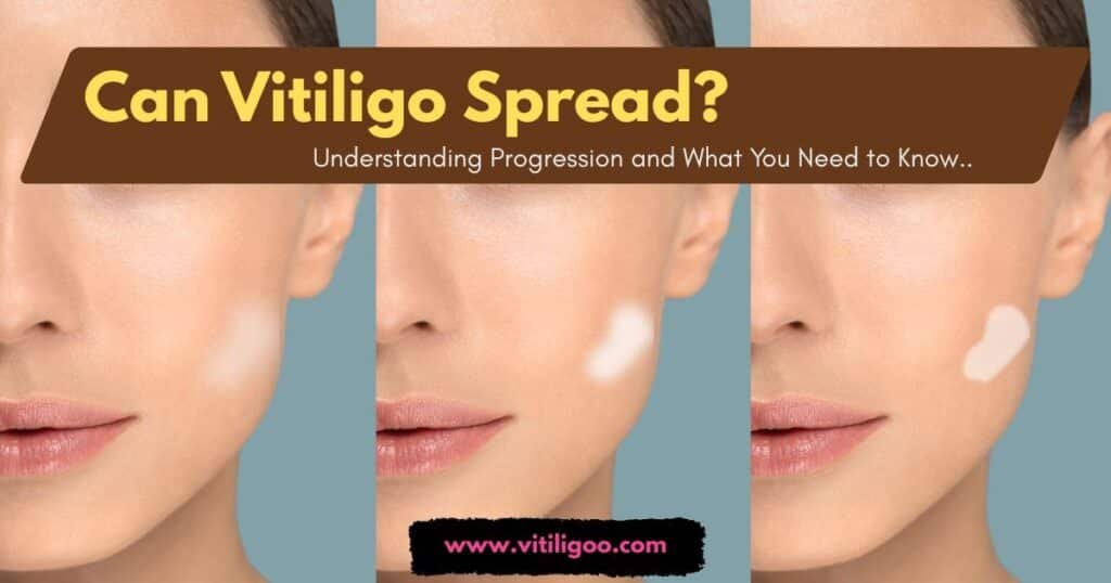 Can Vitiligo Spread? Understanding Progression and What You Need to Know