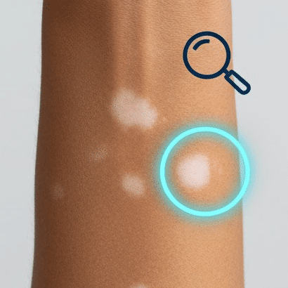 Identifying vitiligo spots early can make a big difference in management and confidence. Vitiligo most often appears as smooth, pale or white patches on the skin, commonly starting on sun-exposed areas like the face, hands, and feet. 